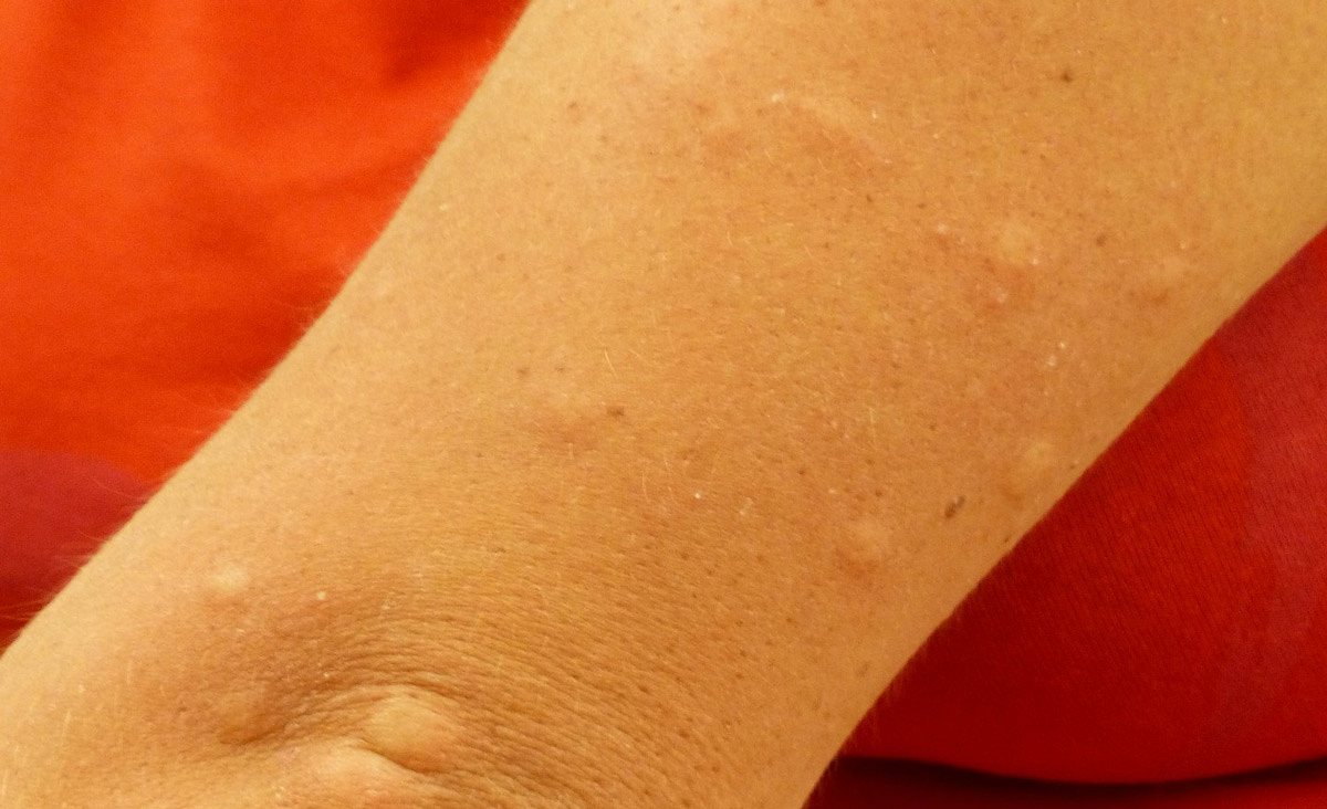 Mückenstiche auf Arm